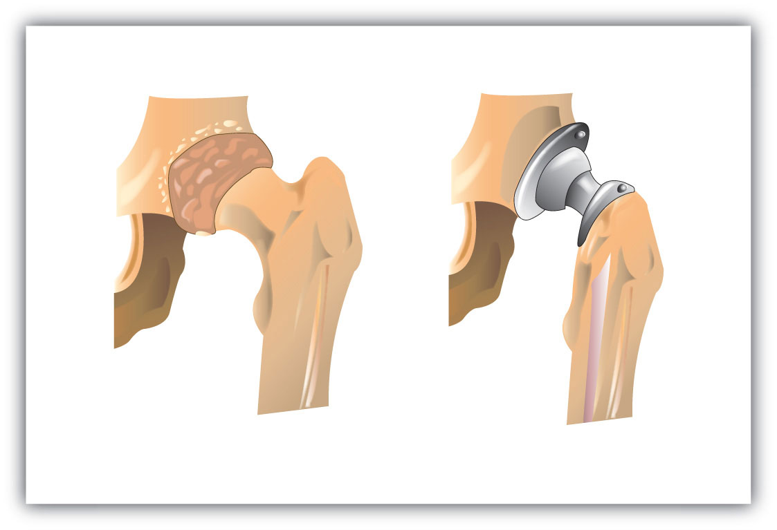 Synthetic polymers are used to create artificial joints. Two joints one before and after the replacement. 