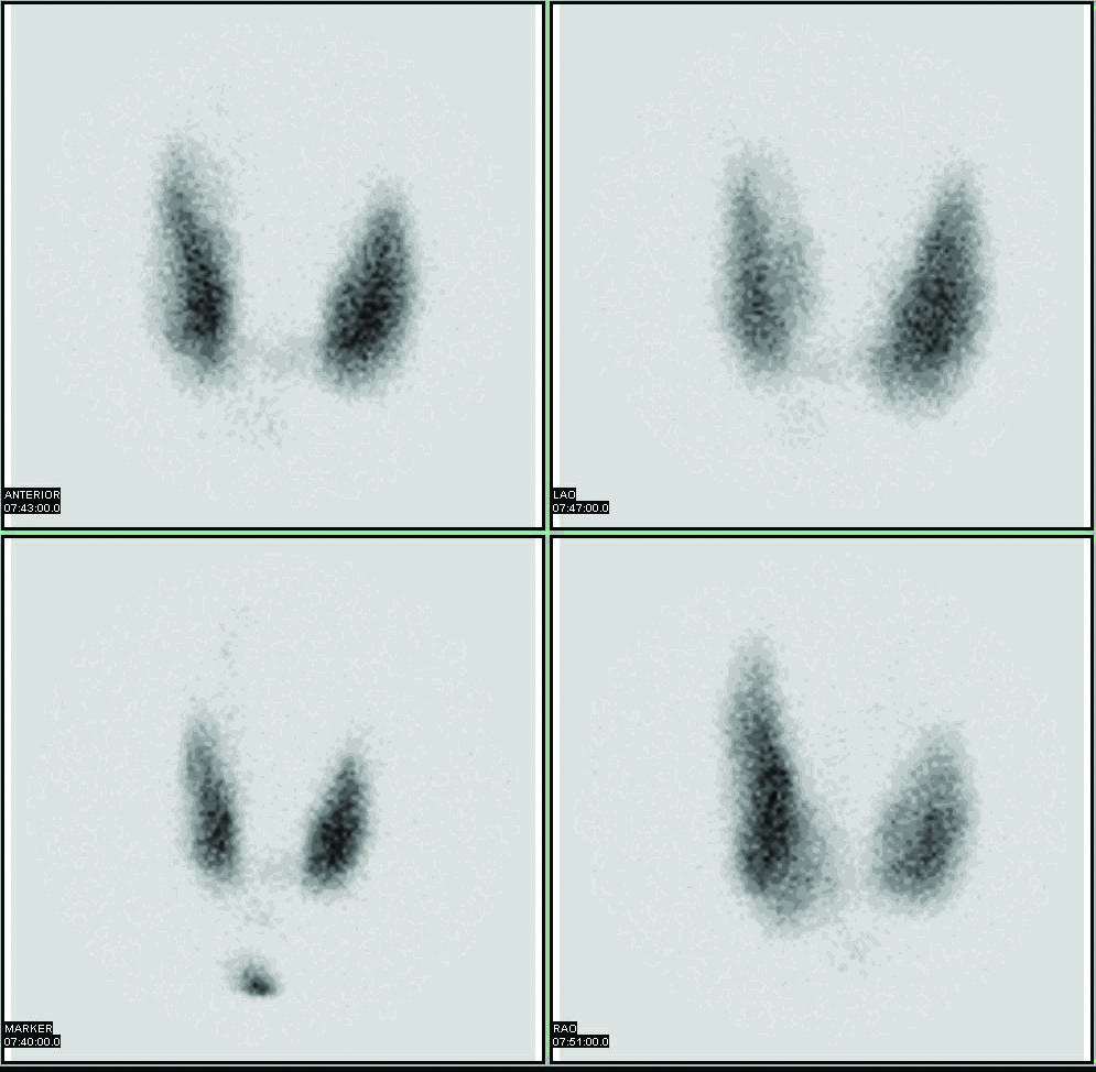 Images of the thyroid gland made with radioactive iodine.